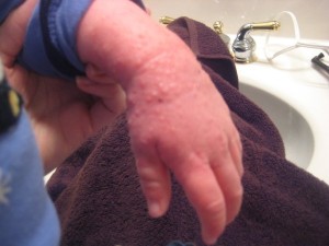 Seth's hand swollen with eczema